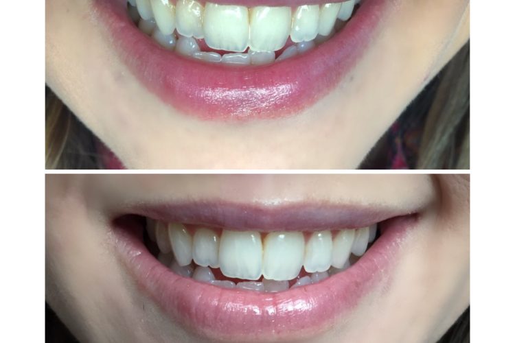 Easy Whitening At Home for Sensitive Teeth